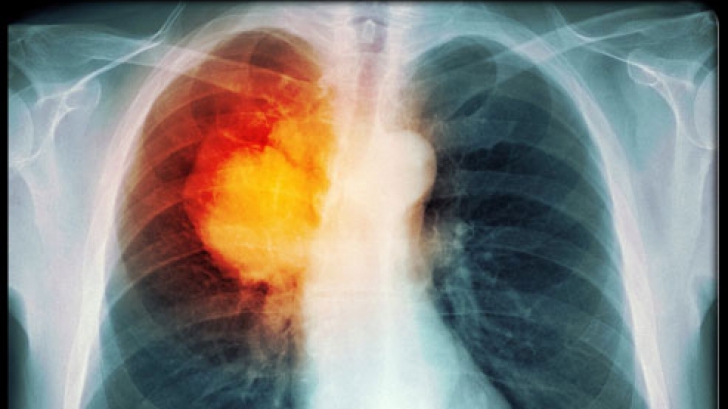 4 simptome ascunse ale cancerului de plămâni. Lumea nu le acordă importanță