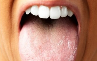 Ai limba crăpată la v&acirc;rf? Mergi URGENT la medic! E vorba despre o boală cumplită!