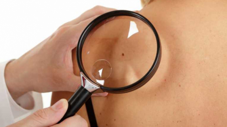 Ce risc ai să faci cancer de piele, în funcție de numărul de aluniţe