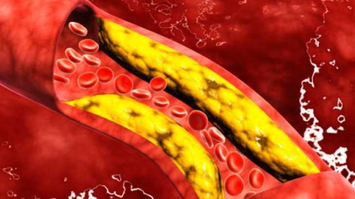 15 semne că ai artere înfundate cu colesterol