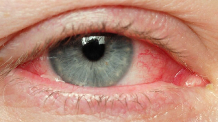 Simptomele unei boli grave apar la ochi. Ce se întâmplă când vezi "în ceaţă"
