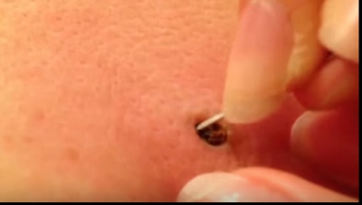 Avea un punct negru pe piele de 25 de ani. A luat o pensetă și a început să tragă. Era să leșine!