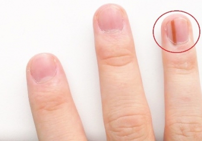 Nici nu-ți dai seama c&acirc;t de grav poate fi. Mergi de urgență la doctor dacă observi asta pe unghia ta