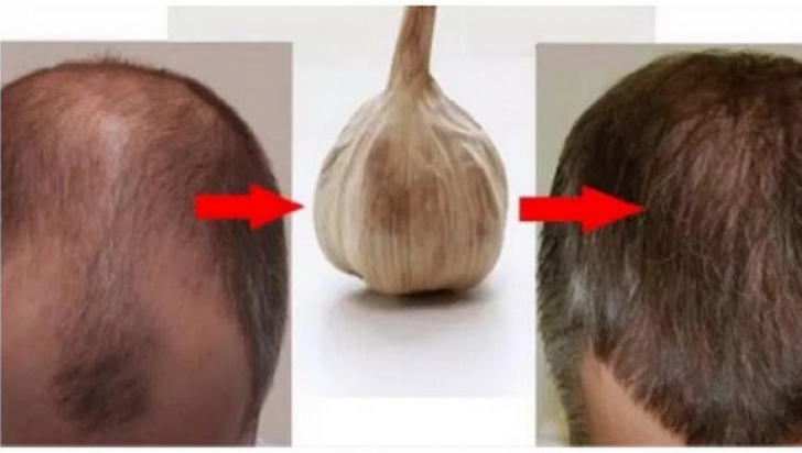 Usturoiul, cel mai bun remediu natural împotriva căderii părului. Ce trebuie să faci