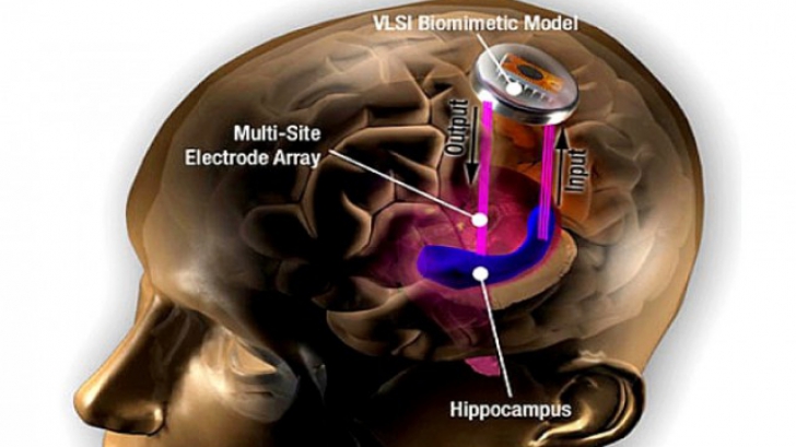 Implanturile în creier devin realitate