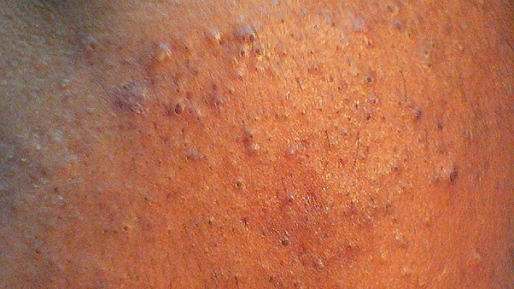 Cum scapi de punctele negre de pe față în 5 minute? Metoda revoluționară! 