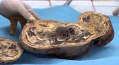 Cazul uimitor al unei femei care a purtat un copil mort &icirc;n p&acirc;ntece timp de 60 de ani