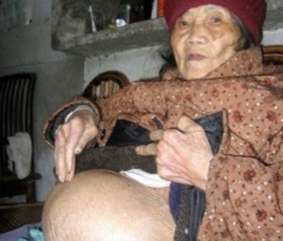 Cazul uimitor al unei femei care a purtat un copil mort &icirc;n p&acirc;ntece timp de 60 de ani