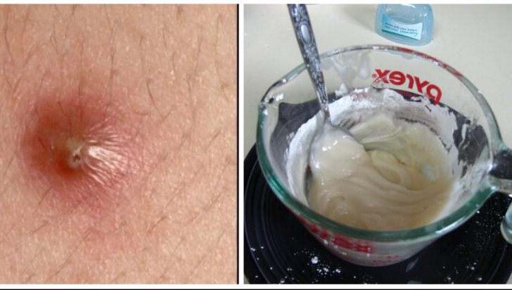 Cum scapi rapid și ieftin de furunculi. Un ingredient banal din bucătărie e salvarea ta