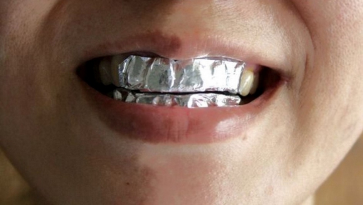 Folie de aluminiu pe dinţi