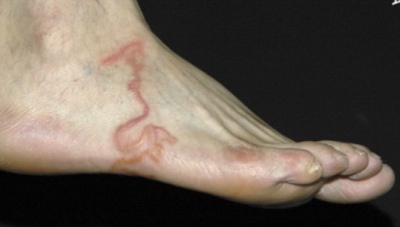 ceea ce este periculos în piciorul varicos