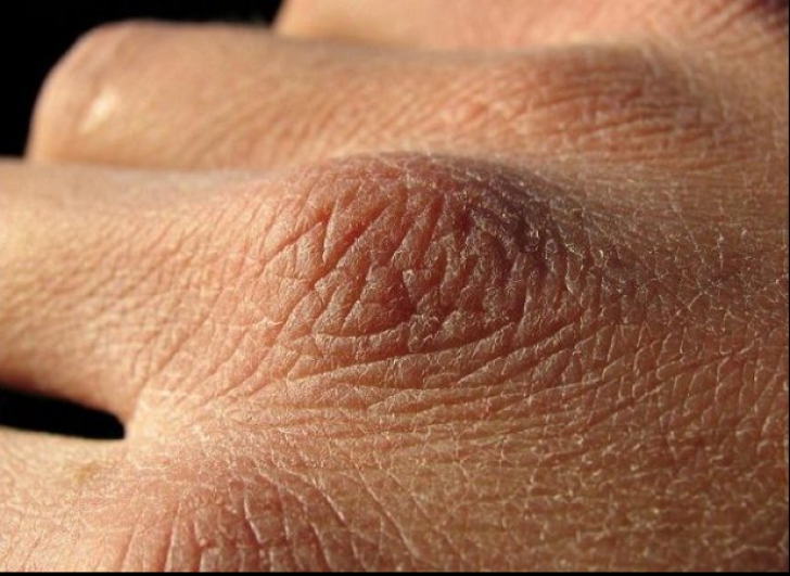 Ce înseamnă dacă pielea de pe mâini arată așa? E un simptom care îți pune în pericol sănătatea