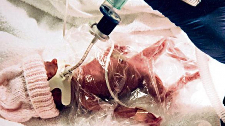 OPERAȚIE inedită. Copil scos din uter și operat, iar apoi plasat la loc până la naștere
