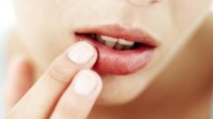 Ce spun despre crăpăturile de la colţul gurii despre sănătatea ta