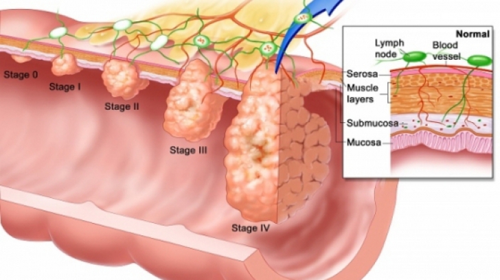 Cancerul de colon nu dă niciun simptom în faza incipientă. Cum pot fi prevenite 98% din cazuri