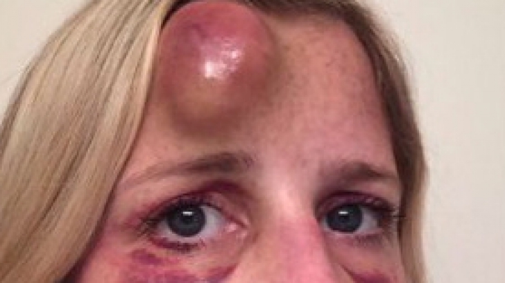 Blonda a mers cu faţa tumefiată la doctor, care i-a spart buba de pe frunte. Ce a urmat e şoc