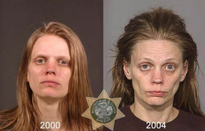 Adevărata faţă a drogurilor. Transformări şocante: înainte şi după consumul de heroină