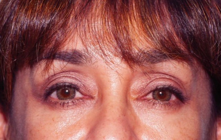 Acest defect al ochilor poate fi un simptom al cancerului la plămâni