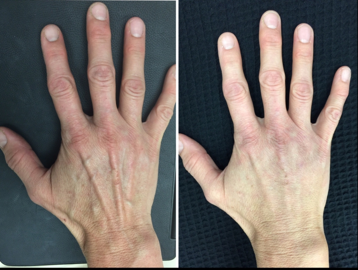 Unguentul minune pentru mâini care elimină ridurile și petele de vârstă