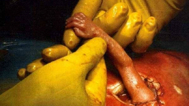 La 21 de săptămâni, copilul nenăscut a prins degetul medicului în timpul operației. Ce a urmat
