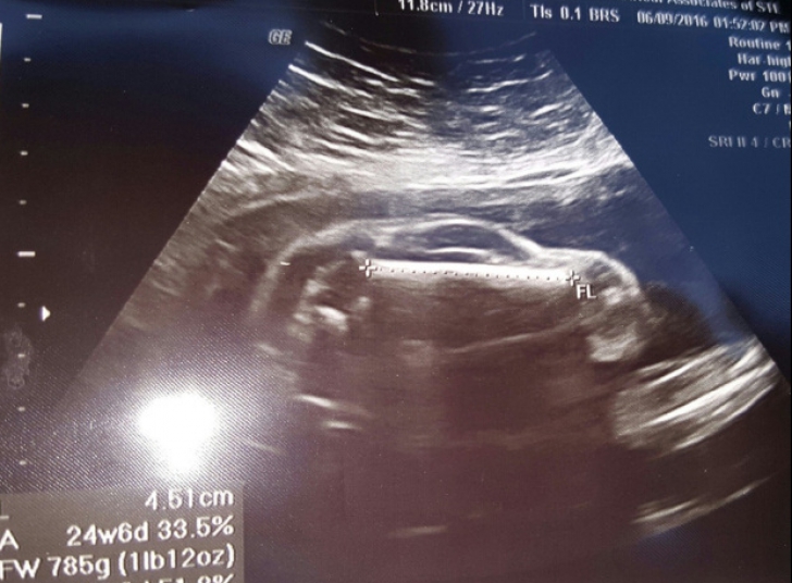 Credea că-și vede copilul la ecografia din timpul sarcinii. Ce a apărut în imagine e incredibil