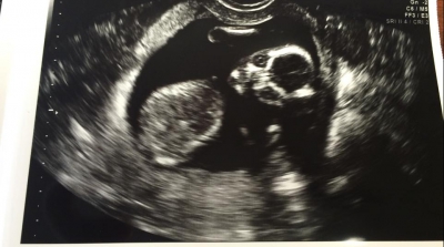 A făcut o ecografie în timpul sarcinii. Când a văzut-o, șoc. ”Nu seamănă cu un copil, ci cu un...”