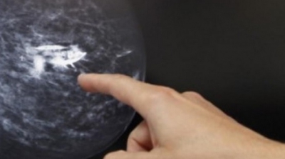 Ce NU spun medicii despre mamografii. Tot ce trebuie să ştii despre screeningul pentru cancer