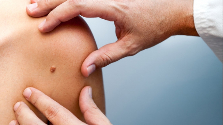 Descoperire șocantă a experților: screening-ul anual pentru cancerul de piele ar putea fi inutil