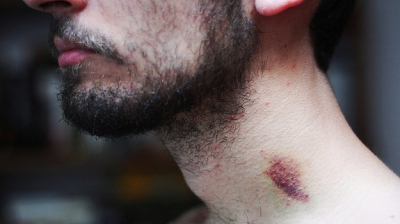 Un t&acirc;năr a murit după ce iubita l-a sărutat pe g&acirc;t! Ce au descoperit medicii