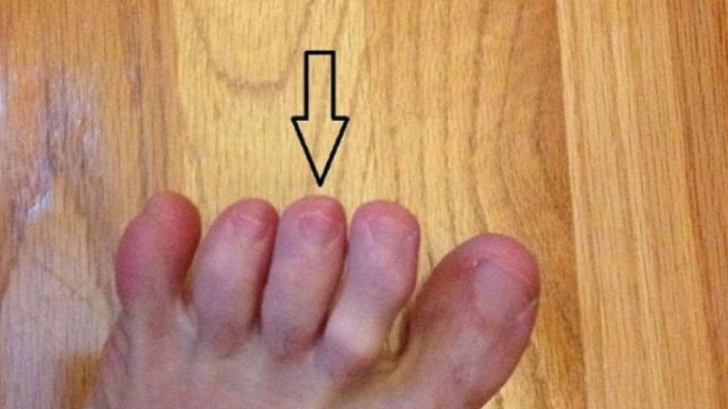 Cancerul de piele poate fi anunțat de degetele de la picioare. Află cum!