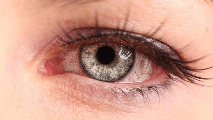 conjunctivita virală a deteriorat vederea