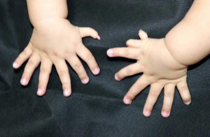 Un bebeluş s-a născut cu 31 de degete! Terifiaţi, medicii au luat o DECIZIE înfiorătoare