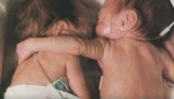 O nou-nascută şi-a îmbrăţisat sora geamănă care era pe moarte. Ce a urmat a şocat lumea medicală!