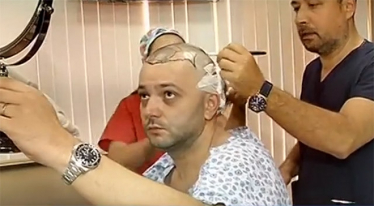 Dovada că Mihai Morar şi-a făcut implant de păr 