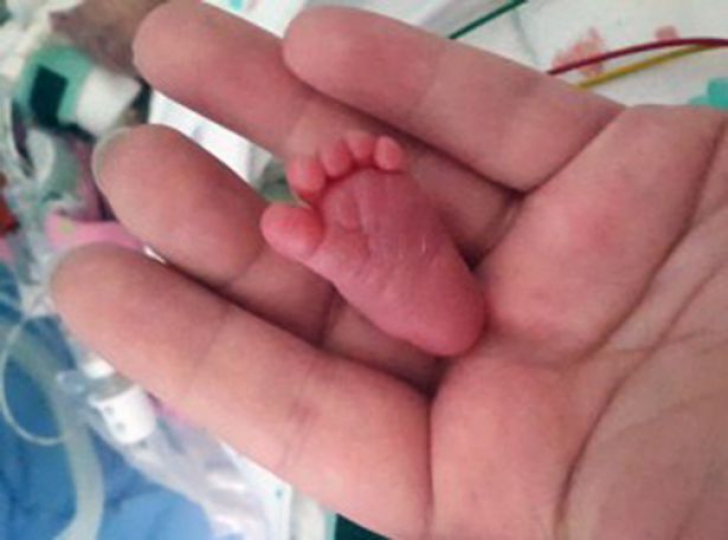 Miracol la Arad: un bebeluş prematur de doar 450 de grame, salvat de medici