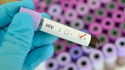 Semne si simptome ale HIV/SIDA care pot fi recunoscute de pacienti