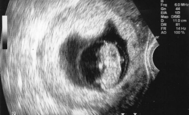 Doctorul a văzut ecografia și i-a spus să avorteze. A refuzat. După 7 luni a născut: Dumnezeule! 