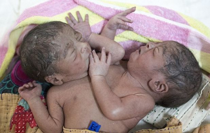 Caz şocant în Bangladesh! Doi siamezi cu 2 capete, 2 mâini şi 2 picioare, abandonaţi în spital