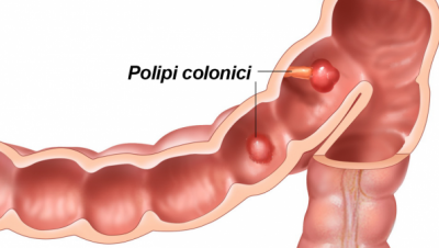 Cum știi dacă ai polipi pe colon și în ce situații pot duce la cancer