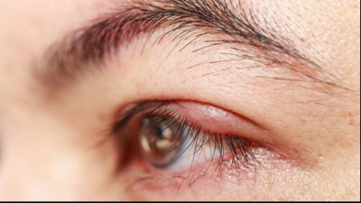 chirurgia ochilor pentru vederea 11 vitamine pentru acuitatea vizuala ce