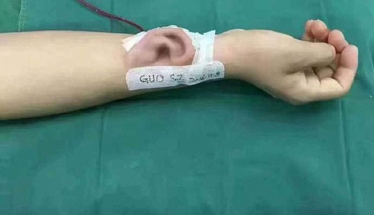 Caz INCREDIBIL: Medicii au reuşit să crească pe mâna unui bărbat o ureche