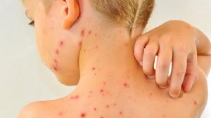 Alarmant! Epidemie de varicelă în Gorj: 70 de copii afectaţi
