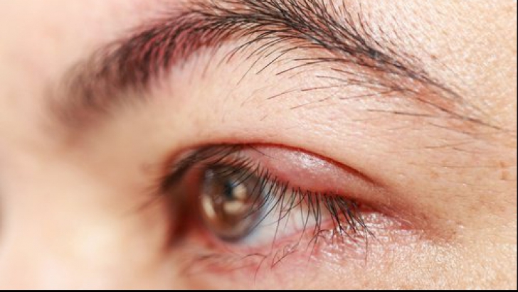 tratament pentru ochi rosii de la curent)