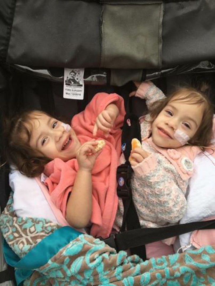 Două surori siameze care au împărţit 2 ani organe vitale, despărţite de o operaţie de 18 ore