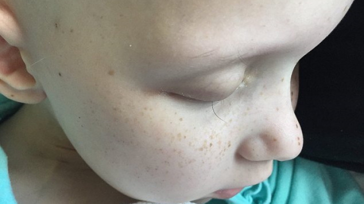 După chimioterapie, această fetiță a rămas cu o singură geană. Povestea ei e impresionantă