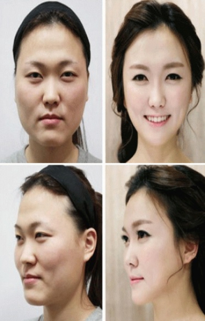 "Minunile" chirurgiei estetice. Cele mai provocatoare intervenţii - transformările, uluitoare!