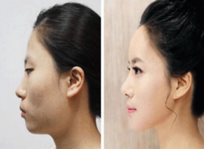 "Minunile" chirurgiei estetice. Cele mai provocatoare intervenţii - transformările, uluitoare!