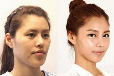 "Minunile" chirurgiei estetice. Cele mai provocatoare intervenţii - transformările, uluitoare!