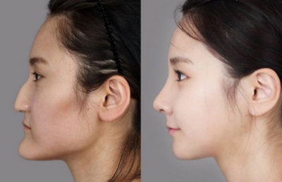 "Minunile" chirurgiei estetice. Cele mai provocatoare intervenţii - transformările, uluitoare!