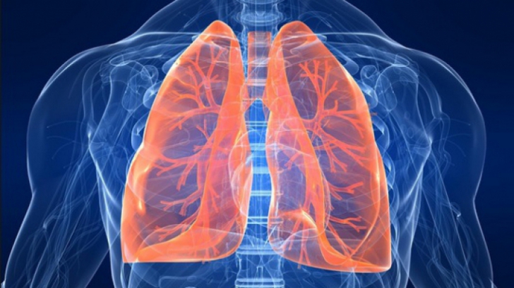 Cancerul pulmonar